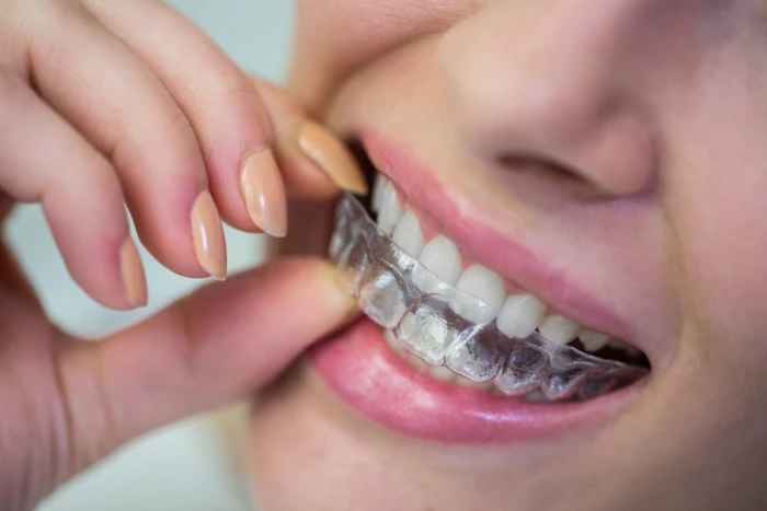 Invisalign Patient Smile - The Dental Project